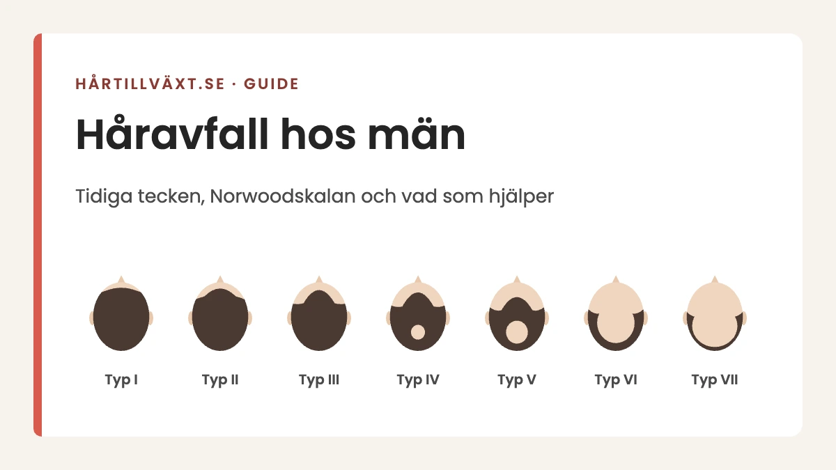 Håravfall hos män: Norwoodskalan typ I–VII, från oförändrat hårfäste till en krans av hår runt sidorna